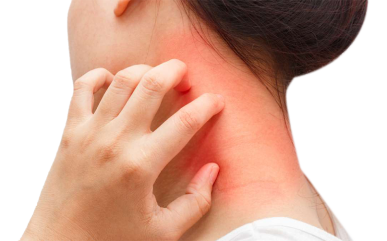 dermatitis-Eczema.png