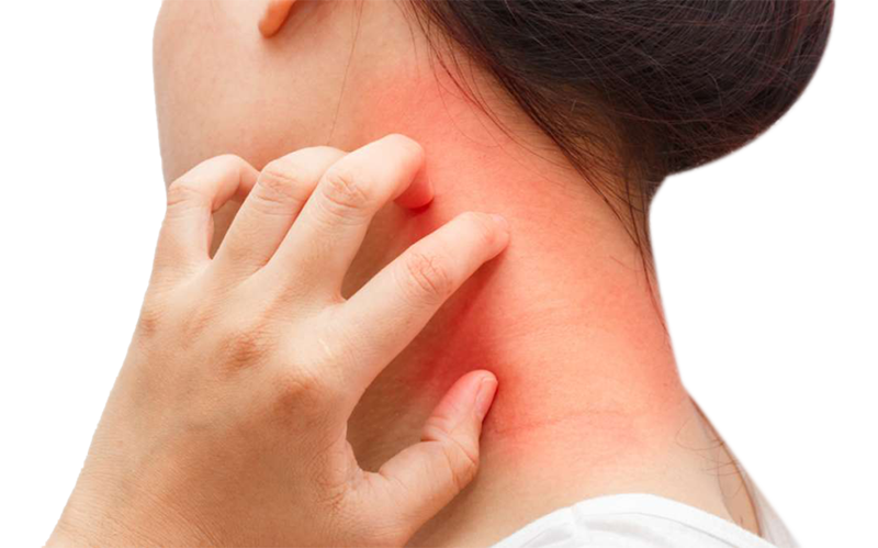 dermatitis-Eczema.png