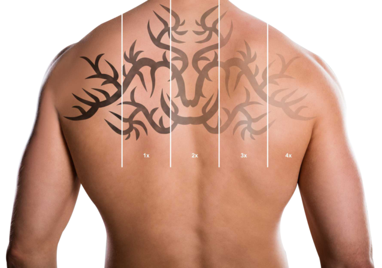 tattoo-laser-removal-01png.png